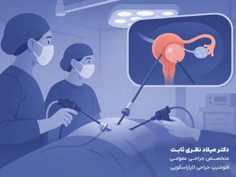 لاپاراسکوپی کیست تخمدان