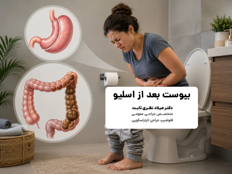 یبوست بعد از اسلیو
