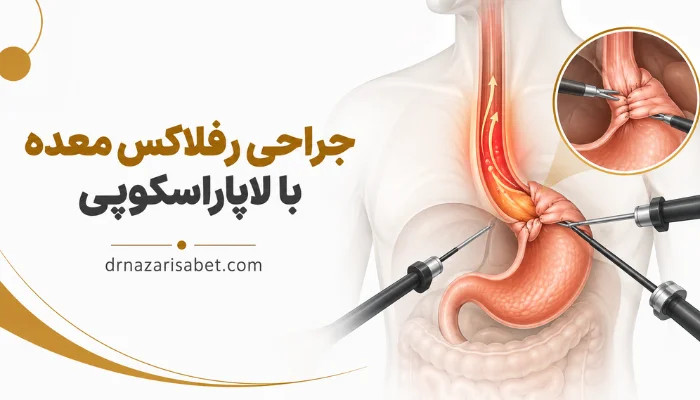 جراحی رفلاکس معده با لاپاراسکوپی و نمایش شماتیک عمل فاندوپلیکاسیون
