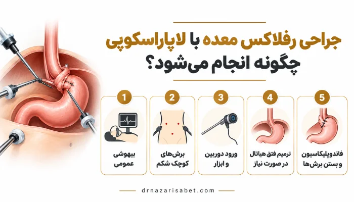 مراحل جراحی رفلاکس معده با لاپاراسکوپی از بیهوشی تا انجام فاندوپلیکاسیون