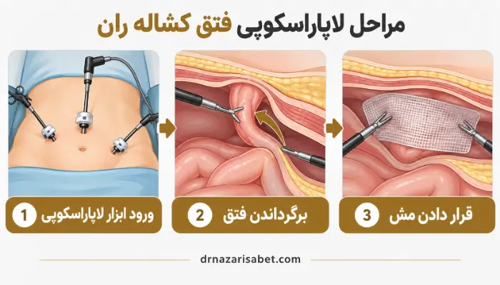 مراحل لاپاراسکوپی فتق کشاله ران شامل ورود ابزار، برگرداندن فتق و قرار دادن مش