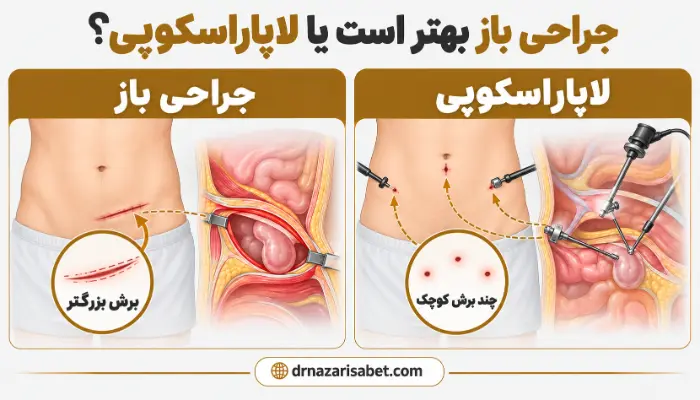 مقایسه جراحی باز و لاپاراسکوپی فتق کشاله ران از نظر نوع برش و مسیر جراحی